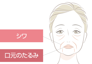 たるみ・シワの図解イラスト