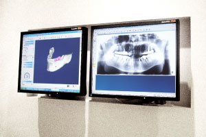 歯科インプラントを装着した状態のレントゲン写真